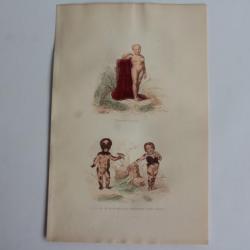 Gravure BUFFON Petite fille couverte de taches velues XIXe siècle