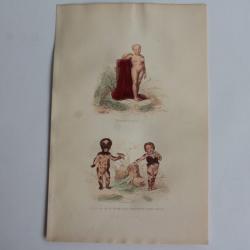 Gravure BUFFON Petite fille couverte de taches velues  XIXe siècle