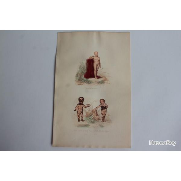 Gravure BUFFON Petite fille couverte de taches velues  XIXe sicle